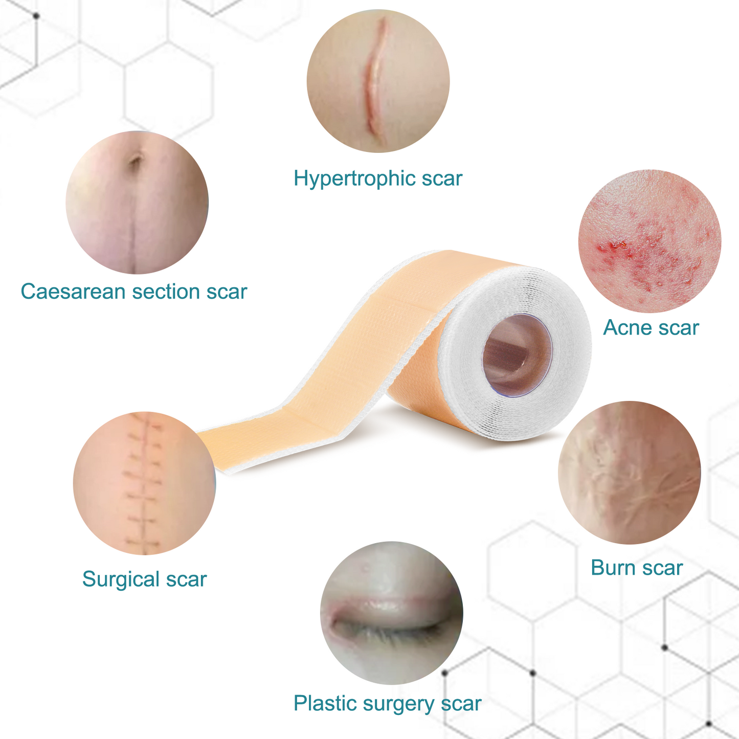 Silicone Scar Sheets, Professional Silicone Scar Sheets,Scar Silicone Tape Strips, Scar Removal Sheets for C-Section,Surgery,Burn,Keloid,Acne (1.5 Meters(4 Month Supply)