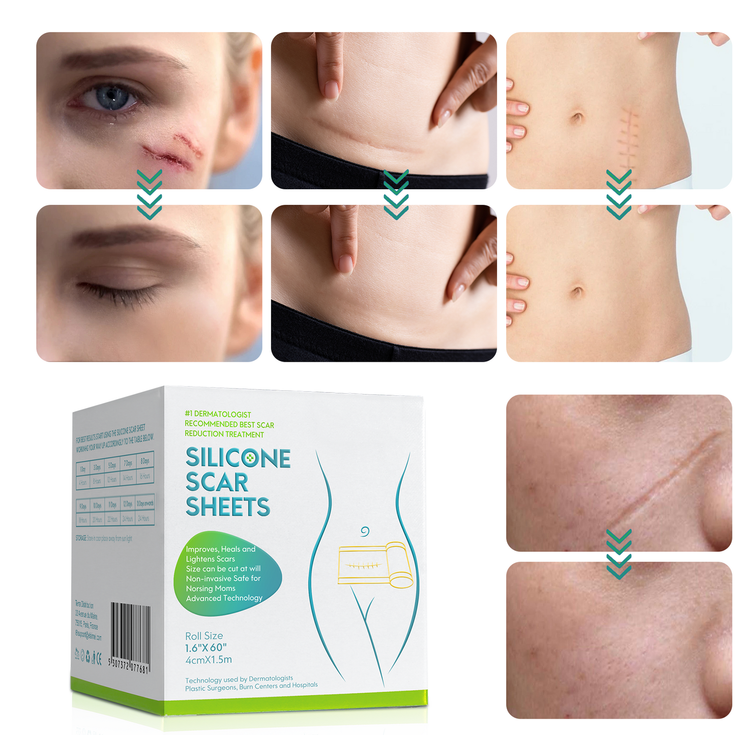 Silicone Scar Sheets, Professional Silicone Scar Sheets,Scar Silicone Tape Strips, Scar Removal Sheets for C-Section,Surgery,Burn,Keloid,Acne (1.5 Meters(4 Month Supply)