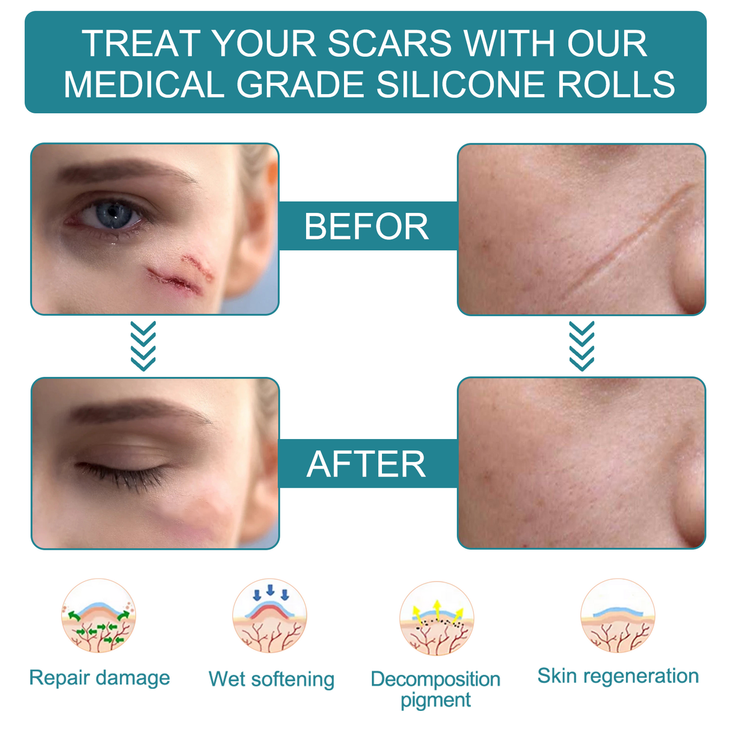 Silicone Scar Sheets, Professional Silicone Scar Sheets,Scar Silicone Tape Strips, Scar Removal Sheets for C-Section,Surgery,Burn,Keloid,Acne (1.5 Meters(4 Month Supply)